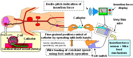 Figure:Mechanism of cerebral aneurysm coil embolization